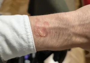 Galaxy Watch User Reports Blister After Suspected Overnight Burn - header